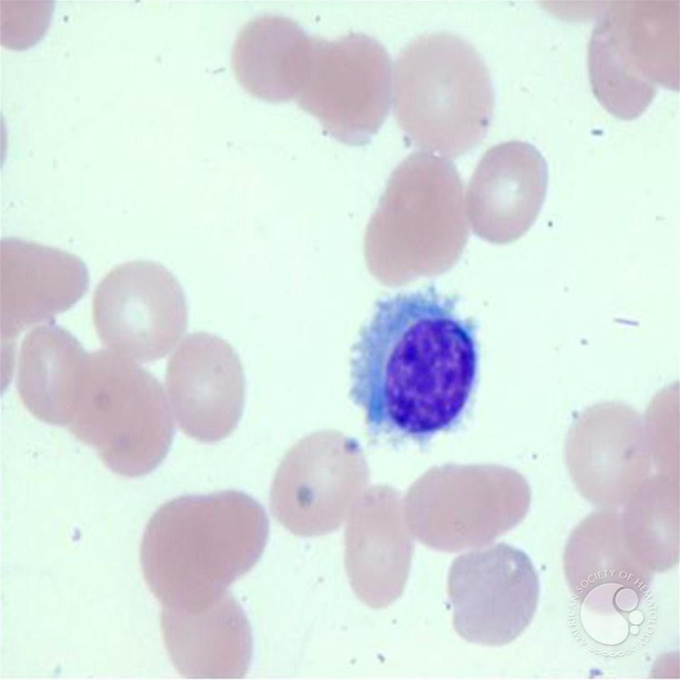 Hairy Cell Leukimia 102