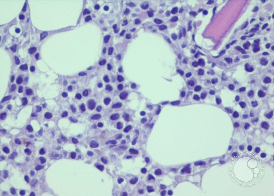 Bone Marrow Biopsy in Hairy Cell Leukemia : The fried egg appearance