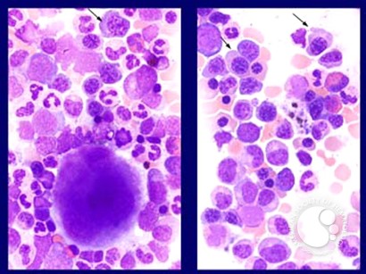 Myelodysplastic Syndrome: Refractory Anemia with Ringed Sideroblasts (RARS) - 4.