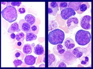 Myelodysplastic Syndrome: Refractory Anemia with Ringed Sideroblasts (RARS) - 5.