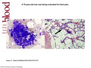 Metastatic adenocarcinoma involving the bone marrow