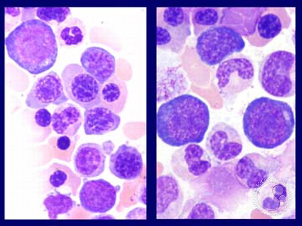 Myelodysplastic Syndrome: Refractory Anemia with Ringed Sideroblasts (RARS) - 5.