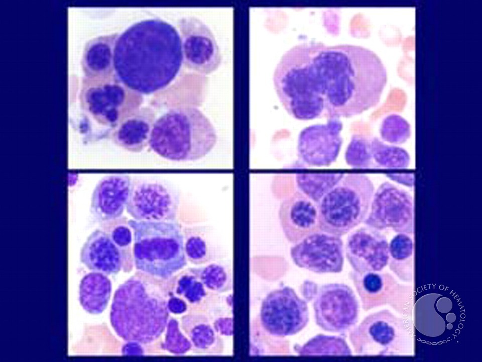 Myelodysplastic Syndrome: Refractory Anemia with Ringed Sideroblasts (RARS) - 6.