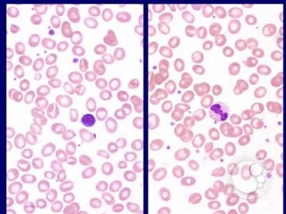 Myelodysplastic Syndrome: Myelodysplastic Syndrome Associated with Isolated del(5q)Chromosome Abnormality ('5q- Syndrome') - 1.