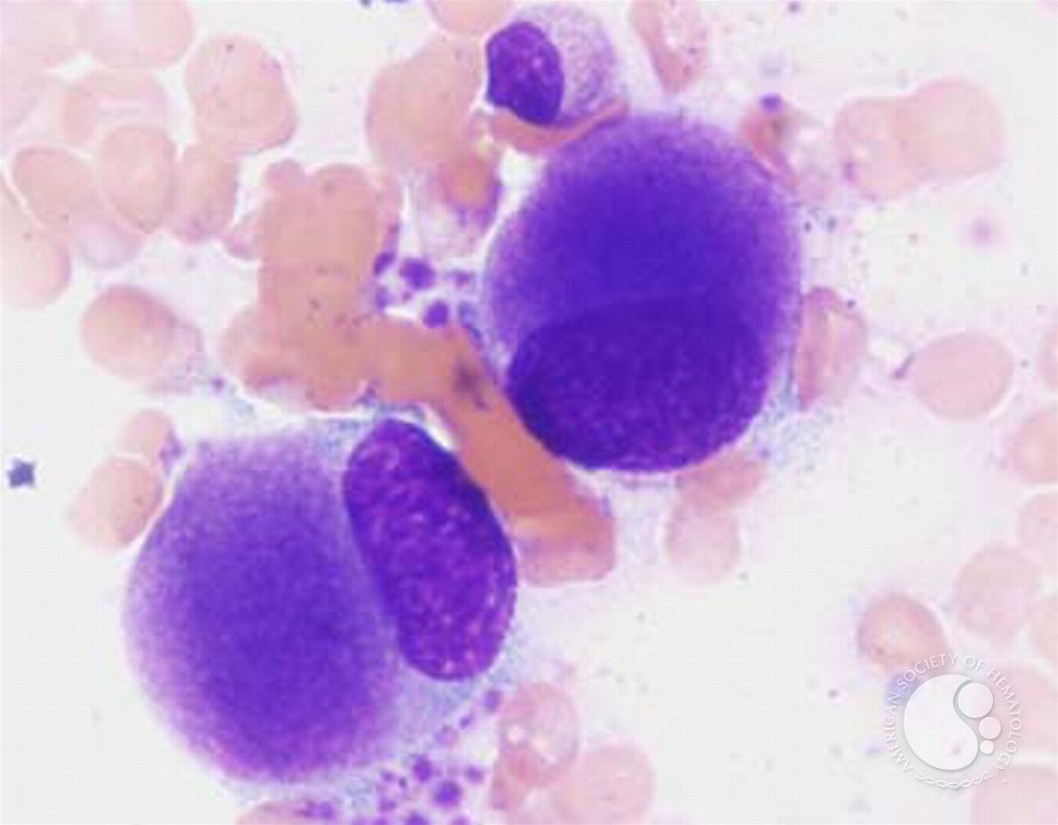 Myelodysplastic Syndrome: Myelodysplastic Syndrome Associated with Isolated del(5q)Chromosome Abnormality ('5q- Syndrome') - 5.