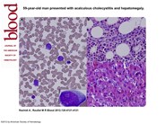 Intravascular large B-cell lymphoma with leukemic component