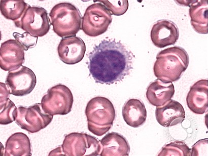 Hairy Cell Leukemia - 2.