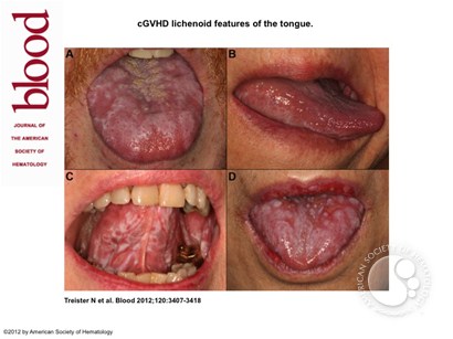 cGVHD lichenoid features of the tongue