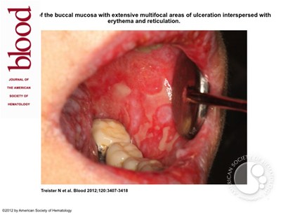 cGVHD of the buccal mucosa