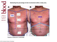 Estimating the percentage of skin involvement within a body area.