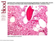 Histologic specimen from a femoral head removed during arthroplasty of a patient after 15 years of ERT