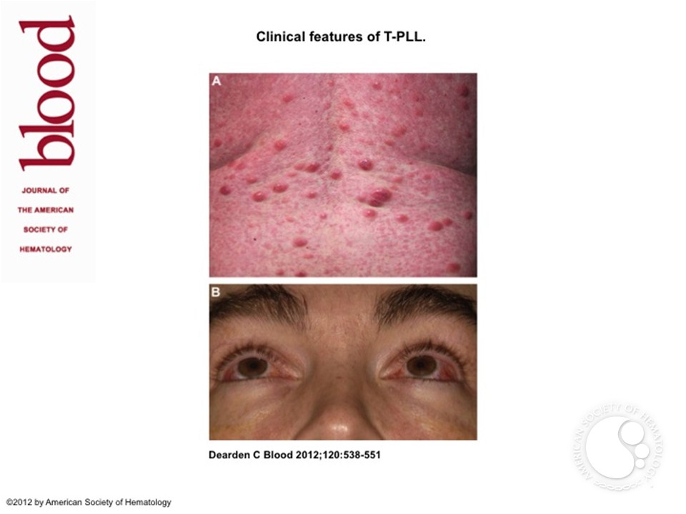 Clinical features of T-PLL