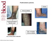 Postthrombotic syndrome