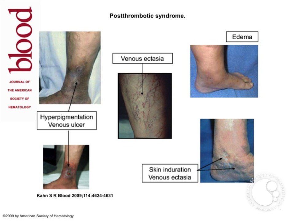 Postthrombotic syndrome