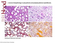Bone marrow histopathology in polycythemia and postpolycythemia myelofibrosis