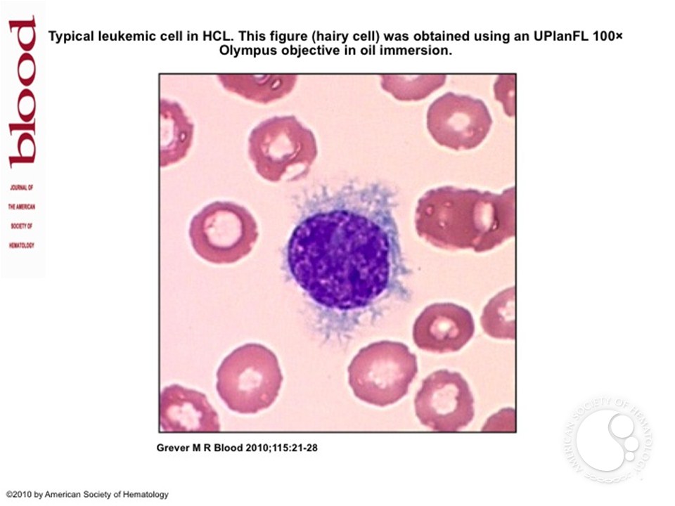 Typical leukemic cell in HCL
