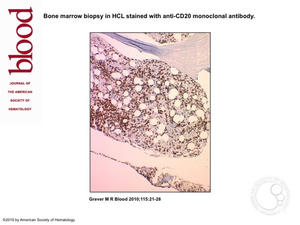 Bone marrow biopsy in HCL stained with anti-CD20 monoclonal antibody