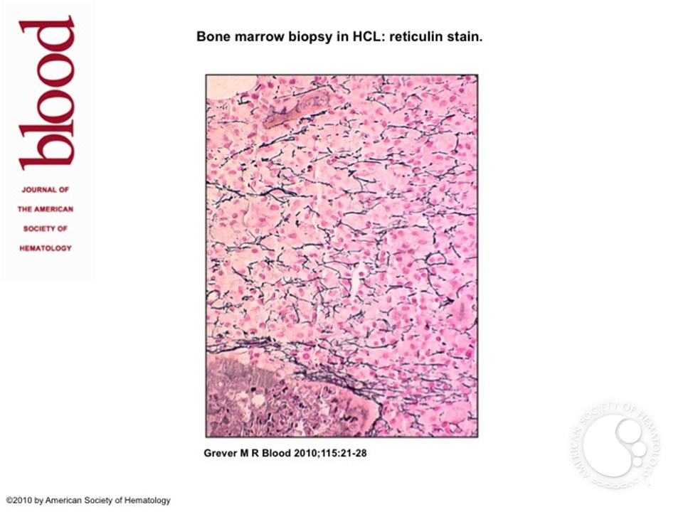 Bone marrow biopsy in HCL: reticulin stain