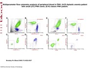 Multiparameter flow cytometry analysis of peripheral blood in PNH