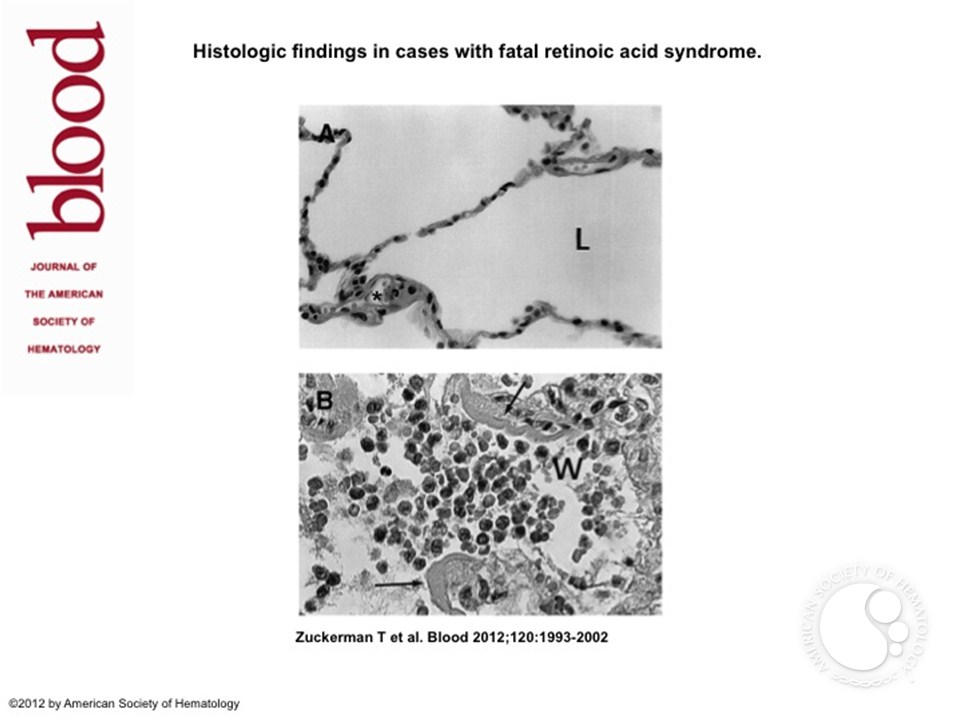 Histologic findings in cases with fatal retinoic acid syndrome