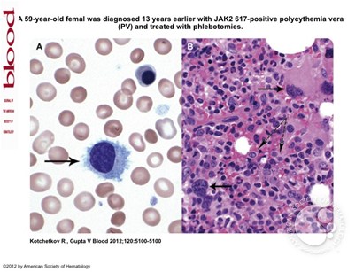 Polycythemia vera followed by hairy cell leukemia variant
