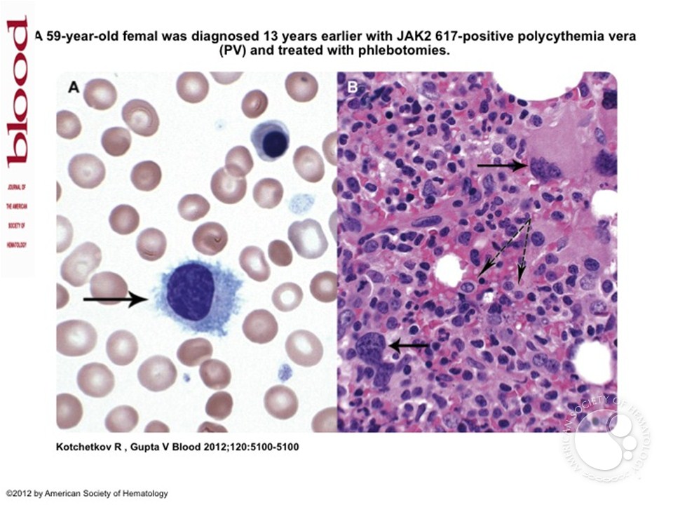 Polycythemia vera followed by hairy cell leukemia variant