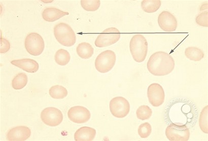 Pernicious Anemia - 1A