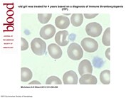 Gray platelet syndrome