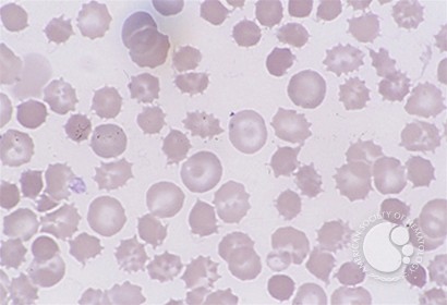 Red Blood Cell Diseases (RBC) 1 - 7.