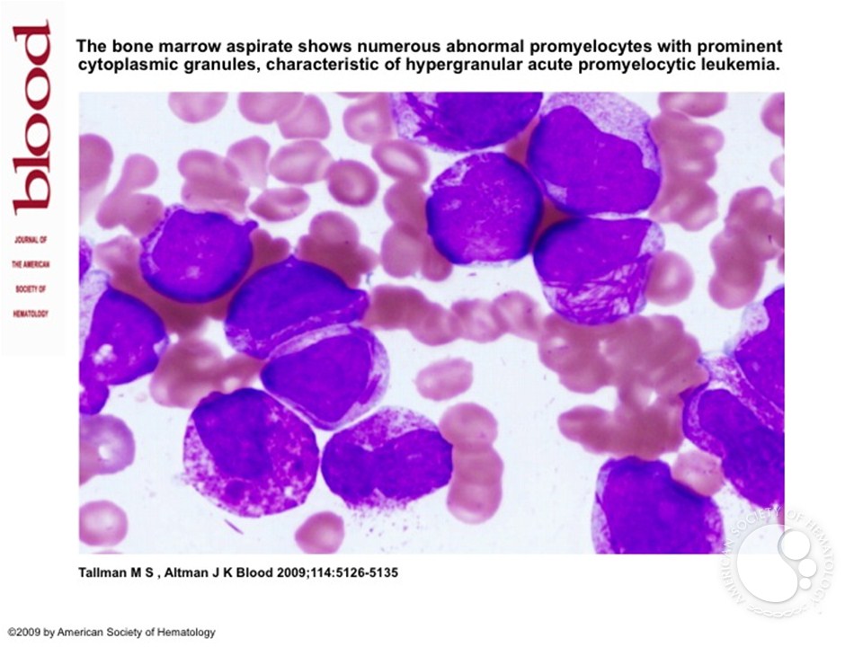 Hypergranular acute promyelocytic leukemia.