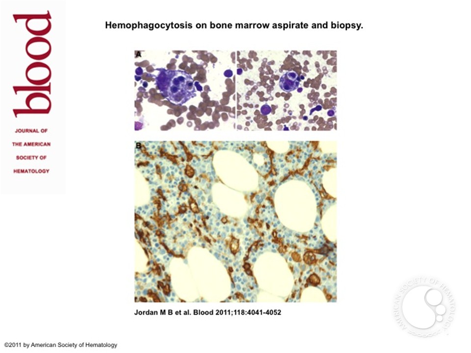 Hemophagocytosis on bone marrow aspirate and biopsy