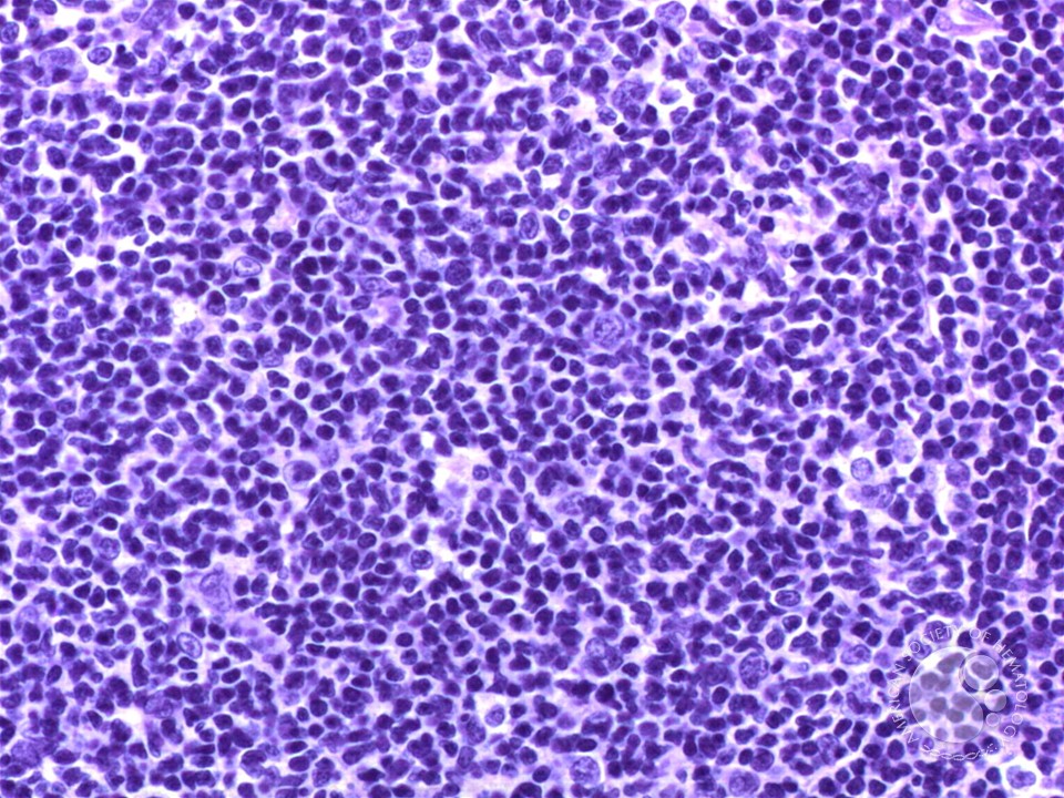 Follicular Lymphoma, Grade 1/3 - 4.