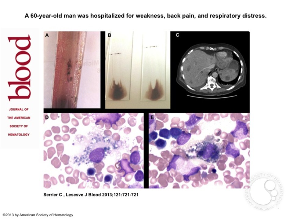 Metastatic malignant melanoma in the bone marrow