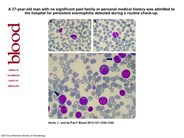 Chronic Eosinophilic Leukemia With Fip1l1 Pdgfra