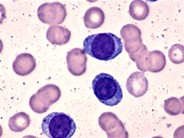 Plasma Cell Leukemia 1