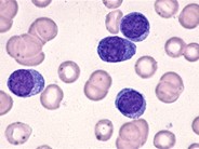Plasma Cell Leukemia - 2.