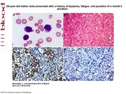 Unusual hairy cell projections in hepatosplenic Tcell non