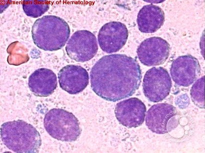 Acute Biphenotypic Leukemia - 3.