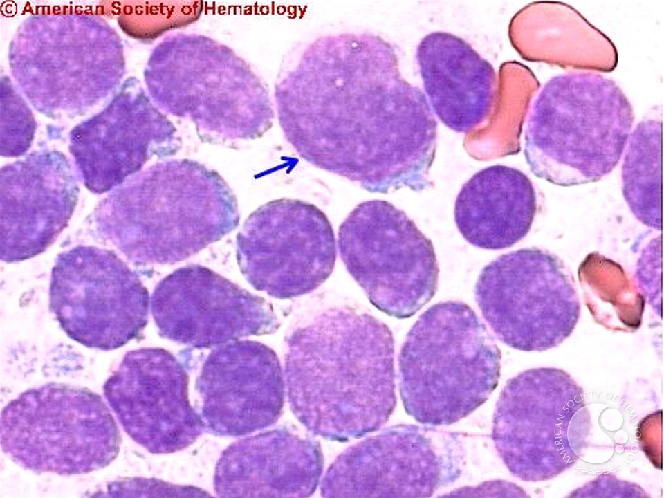 Acute Biphenotypic Leukemia - 4.
