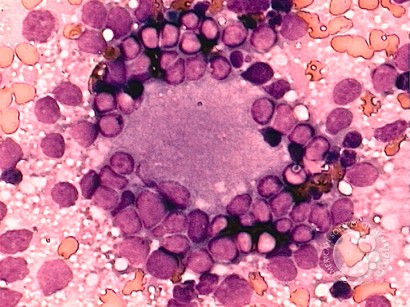 Neuroblastoma - 1.