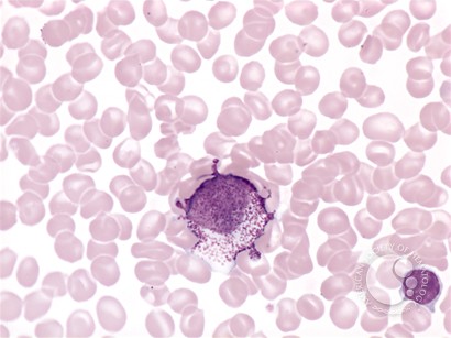 Mast cell leukemia - 1.