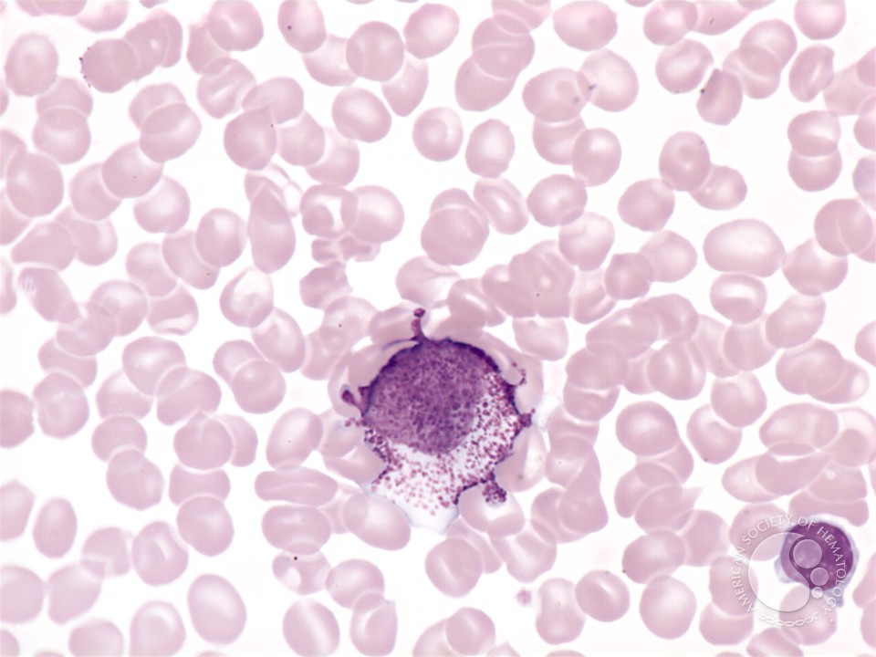 Mast cell leukemia - 1.
