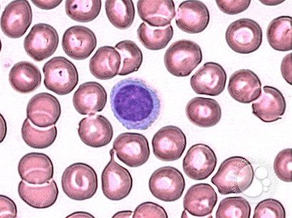 Plasmacytoid lymphocyte - 1.