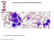 Leukemic phase of ALK-positive anaplastic large cell lymphoma