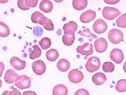 Thrombocytosis (CML) - 1.
