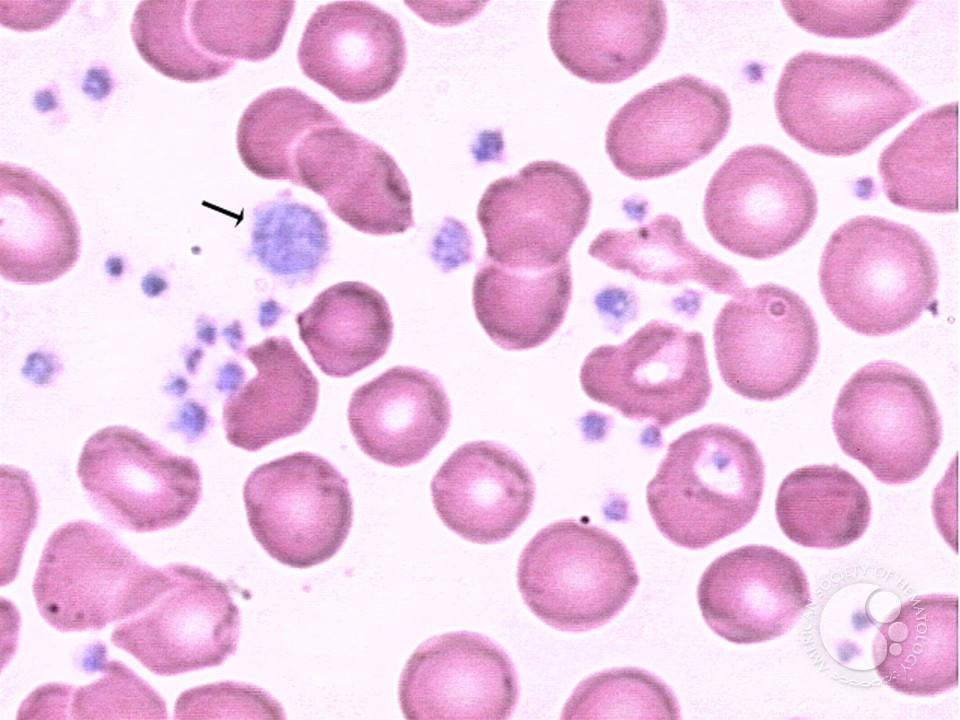 Thrombocytosis (CML) - 1.