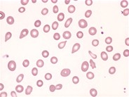 Dacryocytes - 1.