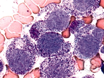 Mast Cell Leukemia - 1.