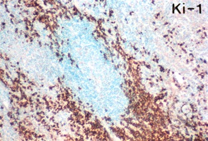 Anaplastic Large Cell Lymphoma - 1.