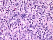Anaplastic Large Cell Lymphoma - 11.